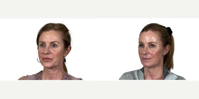 Eyelid Surgery before and after photo