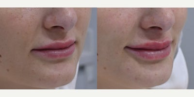 Lip Fillers before and after photo