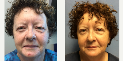 Lower Facelift before and after photo