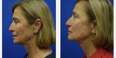 Morpheus8 before and after photo