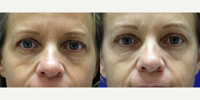 Eyelid Surgery before and after photo