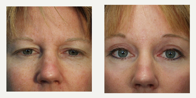 Eyelid Surgery before and after photo