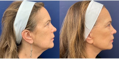 Liposuction before and after photo