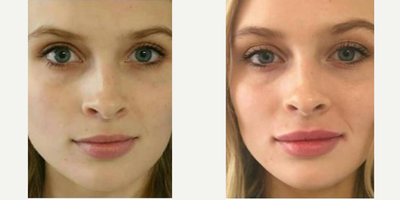 Restylane Refyne before and after photo
