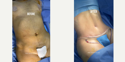 Tummy Tuck before and after photo