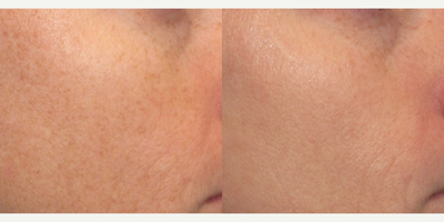 IPL before and after photo