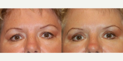 Eyelid Surgery before and after photo