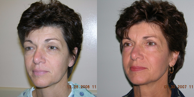 Eyelid Surgery before and after photo