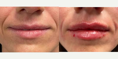Lip Fillers before and after photo
