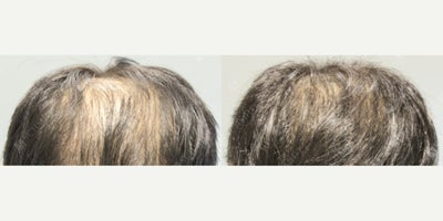 NeoGraft before and after photo