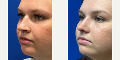Rhinoplasty before and after photo