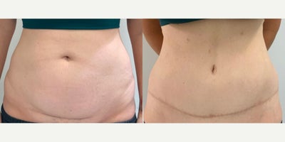 Tumescent Liposuction before and after photo