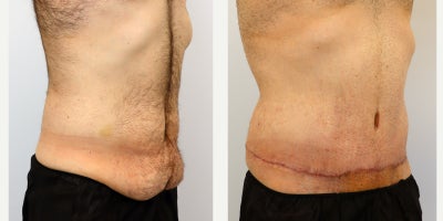 Tummy Tuck before and after photo