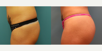 Brazilian Butt Lift before and after photo