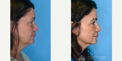 Eyelid Surgery before and after photo