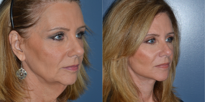 Facelift before and after photo