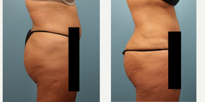 Brazilian Butt Lift before and after photo