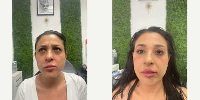 Cheek Fillers before and after photo
