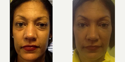 Juvederm before and after photo