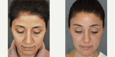 Rhinoplasty before and after photo