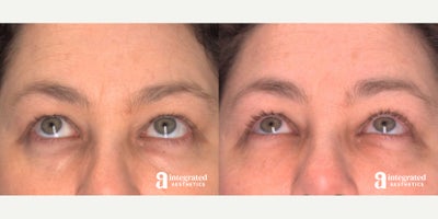 AccuTite before and after photo