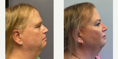 Cheek Augmentation before and after photo