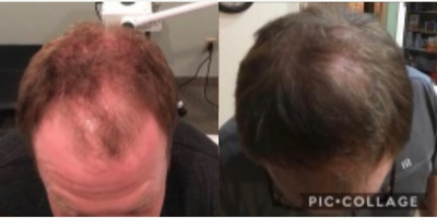 Hair Loss Treatment before and after photo