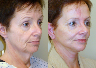 Mini Facelift before and after photo