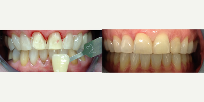 Porcelain Veneers before and after photo