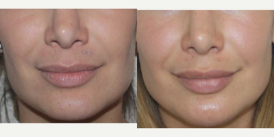 Volbella before and after photo