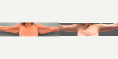 Arm Lift before and after photo