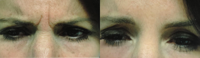 Botox before and after photo