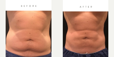 CoolSculpting before and after photo