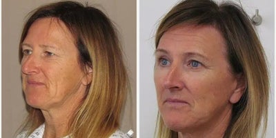 Facelift before and after photo
