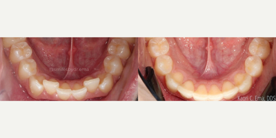 Invisalign before and after photo