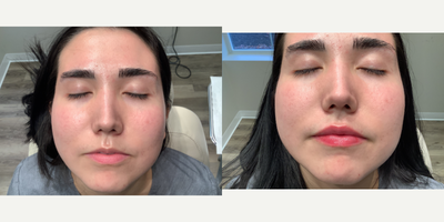 Lip Fillers before and after photo