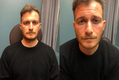 Restylane before and after photo