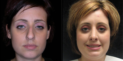 Rhinoplasty before and after photo