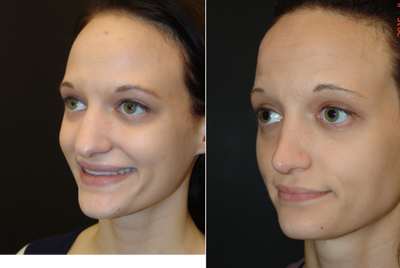Rhinoplasty before and after photo