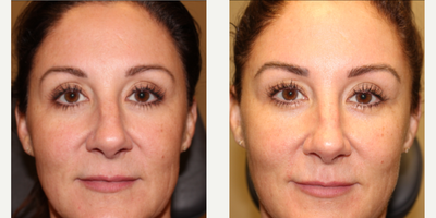 Skin Rejuvenation before and after photo