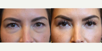 Eyelid Surgery before and after photo