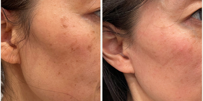 Laser Resurfacing before and after photo