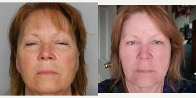 Laser Resurfacing before and after photo