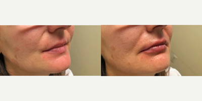 Lip Fillers before and after photo