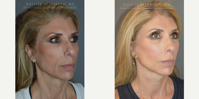 Lower Facelift before and after photo