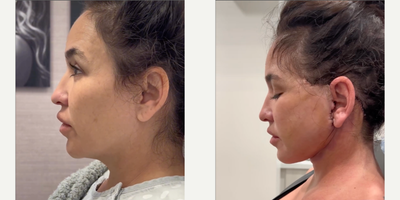 Neck Lift before and after photo