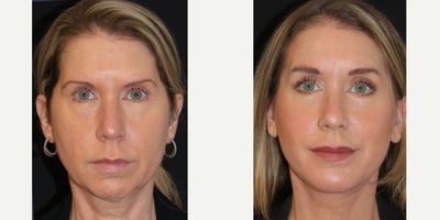 Chin Implant before and after photo