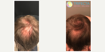 PRP for Hair Loss before and after photo