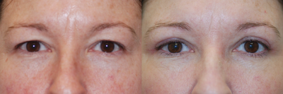 Eyelid Surgery before and after photo