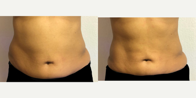 Smart Lipo before and after photo